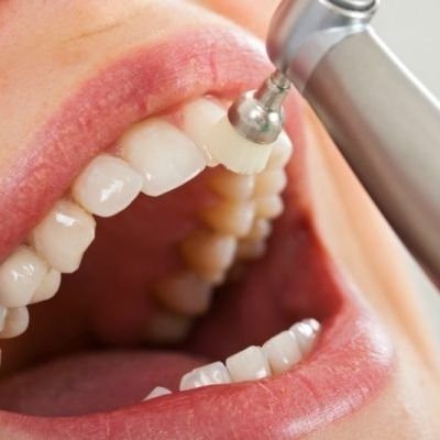 Limpieza dental